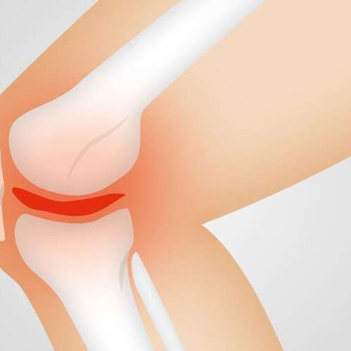 New injectable cell therapy could resolve osteoarthritis