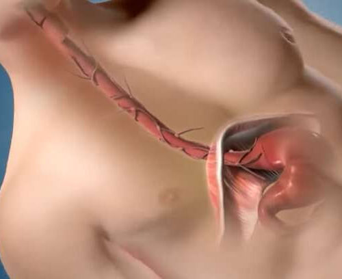 Why early treatment of esophageal cancer is critical