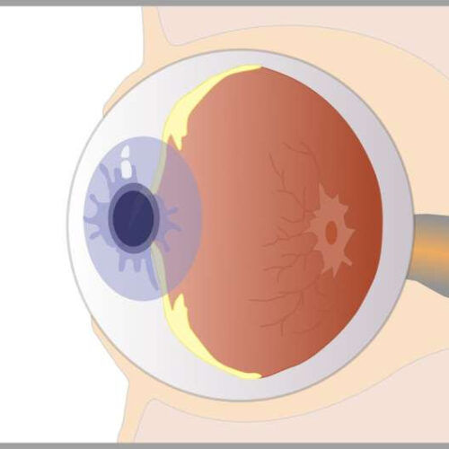 Researchers find that chromatically simulated myopic blur may be useful as a myopia control therapy