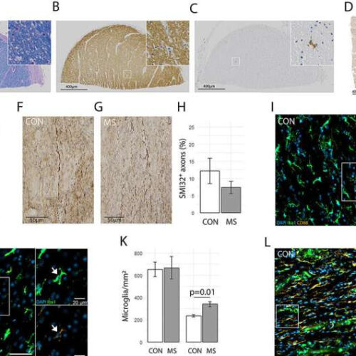 Multiple sclerosis: Ultrastructural changes in brain tissue promote inflammatory processes