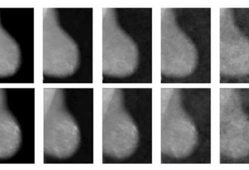 Influence of visual hindsight bias in mammogram reading