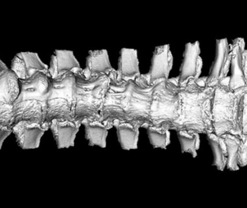 New research sheds light on symptoms of understudied spine disease