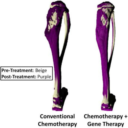 Combination of gene therapy and chemotherapy may provide new treatment option in bone cancer