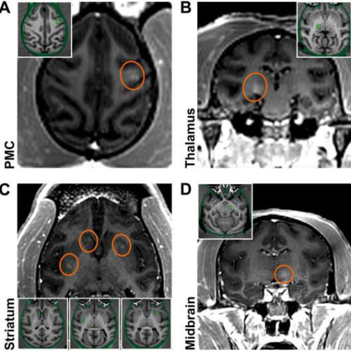 Sneaking past the blood-brain barrier to usher in the age of gene therapy for neurodegenerative disease