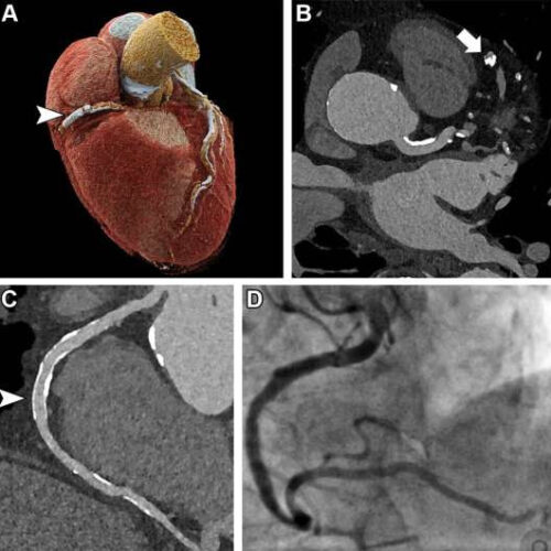 Photon-counting CT noninvasively detects heart disease in high-risk patients