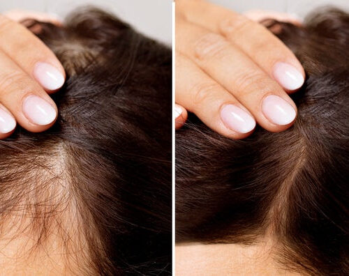 Which Hair Loss Treatment Is Right for Me?