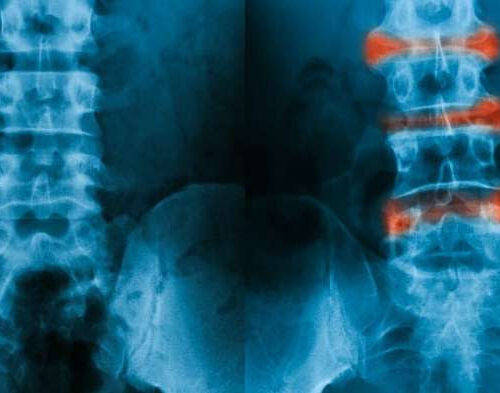 Ankylosing spondylitis: Machine learning could pave the way for early diagnosis of inflammatory arthritis