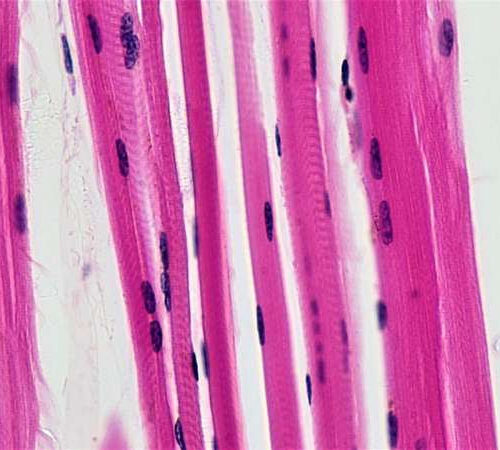 Does fat content within muscle predict risk of cognitive decline?