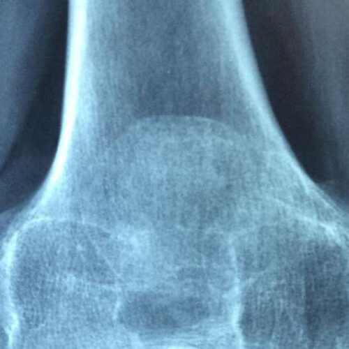 Osteoporosis too often misunderstood and ignored despite its serious health consequences