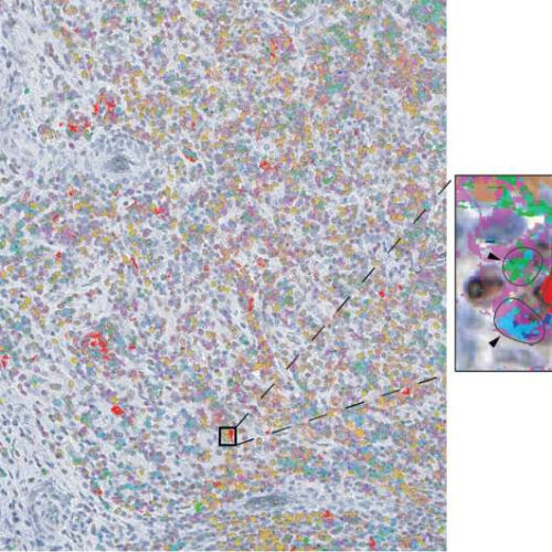 Study reveals a trio of immune cells vital in response to liver cancer immunotherapy