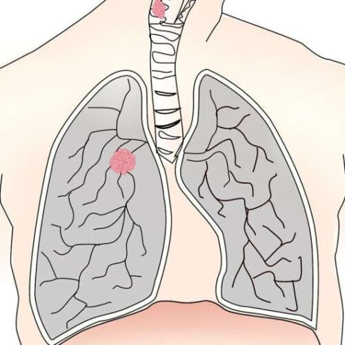 Real-world data suggests stopping immunotherapy after two years is reasonable in patients with advanced lung cancer