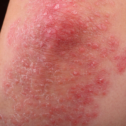 New Study Uncovers Cells and Pathways Driving Psoriasis Inflammation and Severity