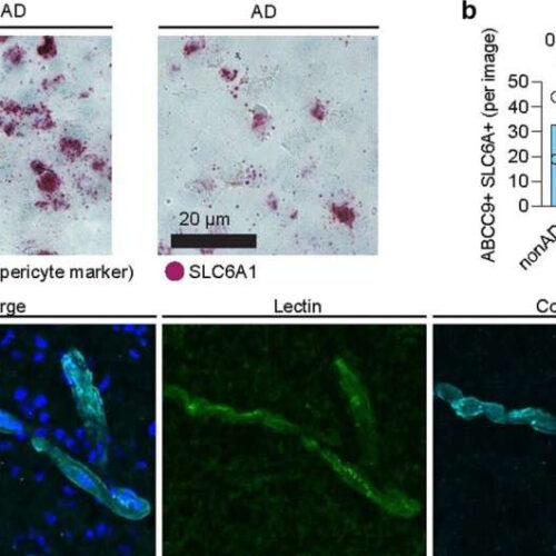 Single-cell dissection of Alzheimer’s vascular changes across six brain regions