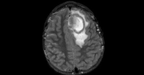 Abnormal Surge of Brain Abscesses in American Children, CDC Says