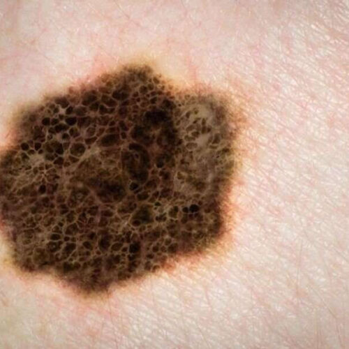 Tips to checking your skin for skin cancer