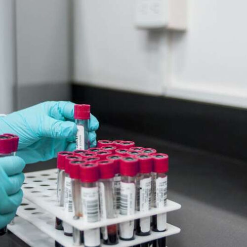 A simple blood test can diagnose neurometabolic condition, De Vivo disease