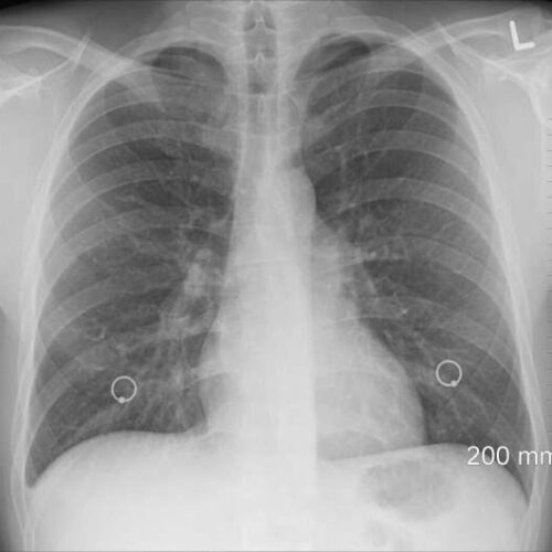 Lung infection caused by a little-known bacterium may be less transmissible than thought