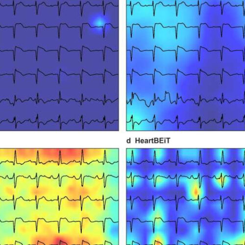 Researchers use new deep learning approach to enable analysis of electrocardiograms as language