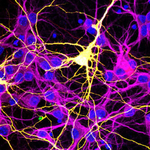 Could fused neurons explain COVID-19’s ‘brain fog’?