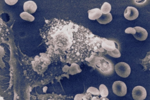 Engineered White Blood Cells Eliminate Cancer