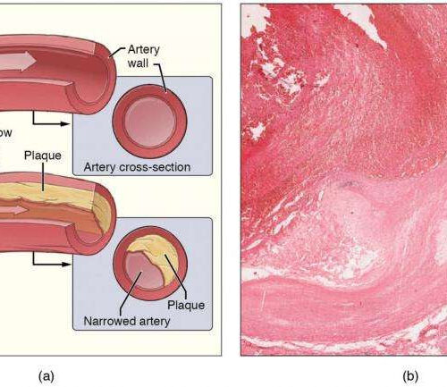 Experimental cancer drug may slow inflammation linked to heart disease