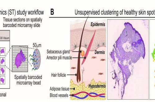 Study helps explain what drives psoriasis severity and offers clues as to how disease may spread to other body parts