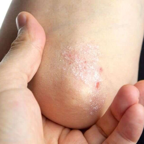 Early intervention for psoriasis with guselkumab tied to complete response