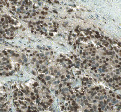 Study reveals how treatment-resistant prostate cancer provides its own hormonal fuel