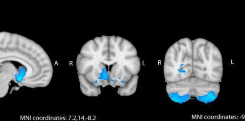 Gout strongly associated with reduced gray matter and increased neurodegenerative disease