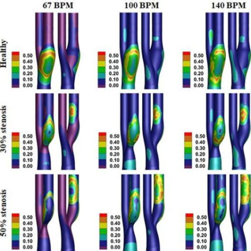 Exercise may induce strokes for people with blocked arteries