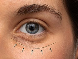 FDA Approves Hyaluronic Acid Filler for Under-Eye Hollows