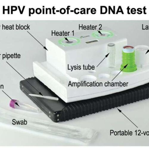 DNA test could broaden access to cervical cancer screening