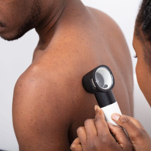 Black men are more likely to die from skin cancer because they’re getting diagnosed later. Here are 3 early signs to watch out for