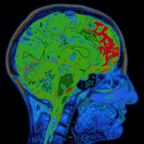 People with obsessive-compulsive disorder have an imbalance of brain chemicals – our discovery could mean a treatment breakthrough