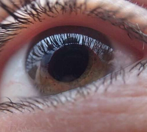 Genetic discovery could help prevent irreversible blindness in people with glaucoma