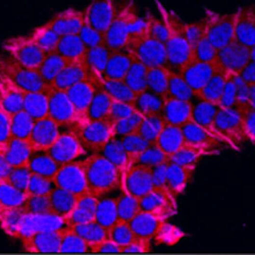 Outpatient stem cell transplants result in less hospitalization time for multiple myeloma patients, study finds