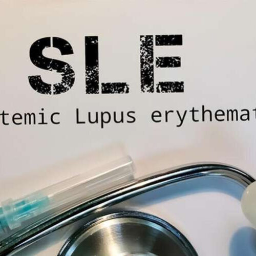 Dissecting the genetic factors involved in systemic lupus erythematosus development