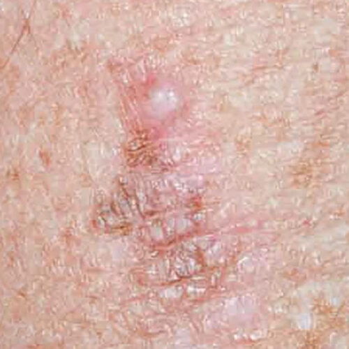 What can cause a white mole on the skin?
