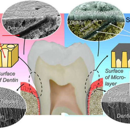 Dental lozenge could provide permanent treatment for tooth sensitivity