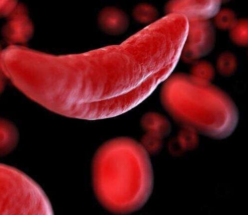Sickle cell disease is 11 times more deadly than previously recorded, suggests study