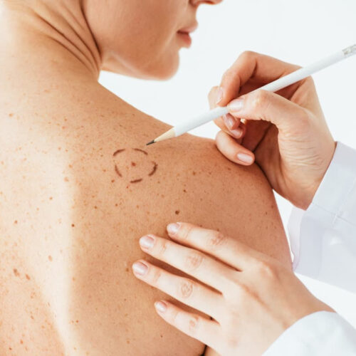 Fecal transplants may boost the success of melanoma treatment