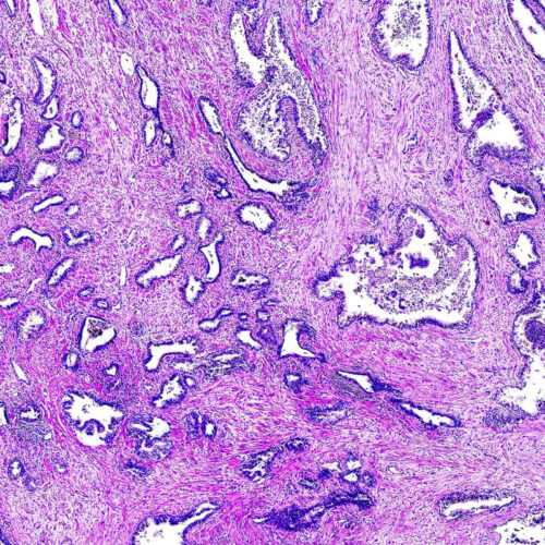 New prostate cancer biomarkers to help improve diagnosis and treatment