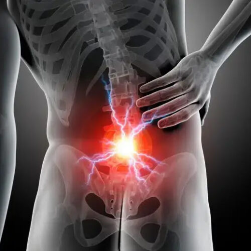 New Analysis Dispels Common Back Pain Myth and Reveals a Looming Crisis