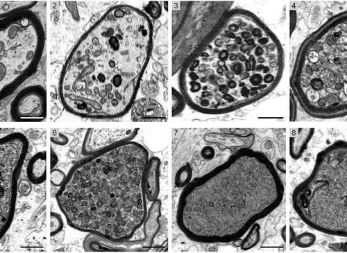 Multiple sclerosis: Myelin may be detrimental to nerve fibres