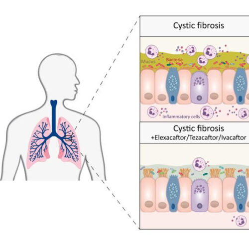 Triple combination therapy brings lasting improvement in cystic fibrosis