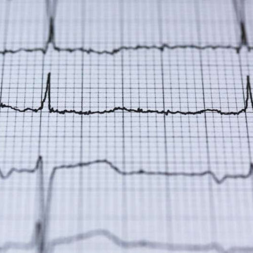 New AI tool beats standard approaches for detecting heart attacks