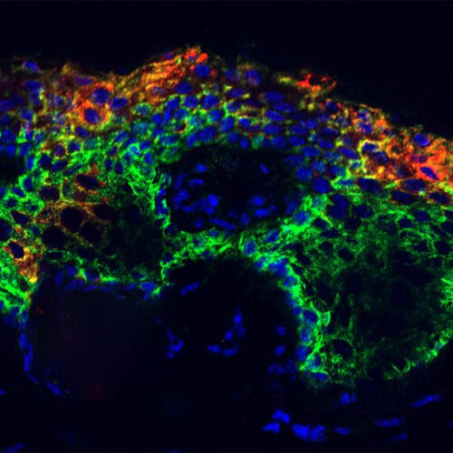 Researchers find an epigenetic key that unlocks common deadly cancers