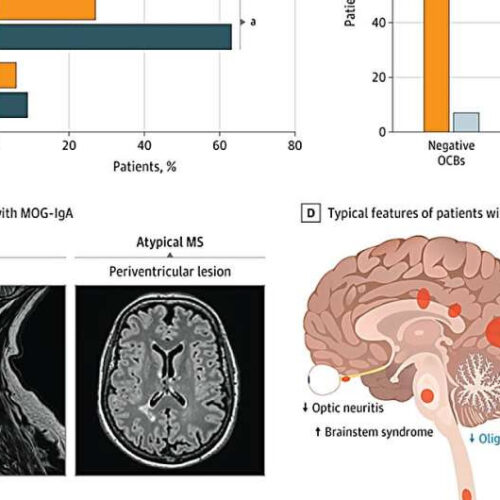 Possible biomarker of MS-like autoimmune disease discovered