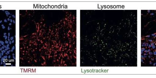 Scientists harness the power of AI to shed light on different types of Parkinson’s disease