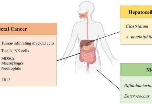 Gut microbiota and immune alteration in cancer development: Implications for immunotherapy